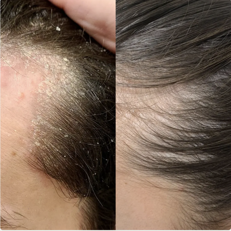 Before and after results from Samantha R.